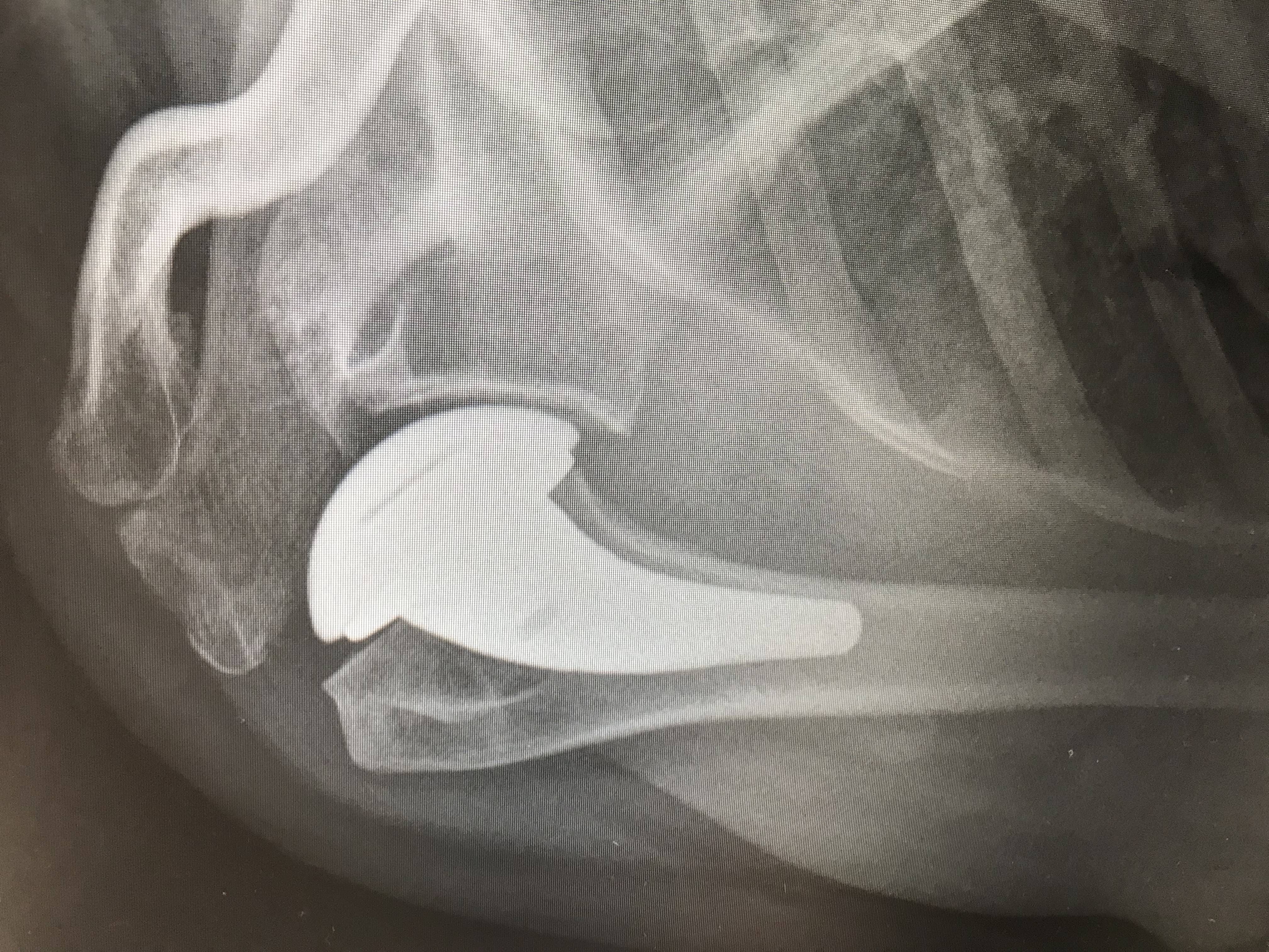 X-Ray of Knee Replacement 2