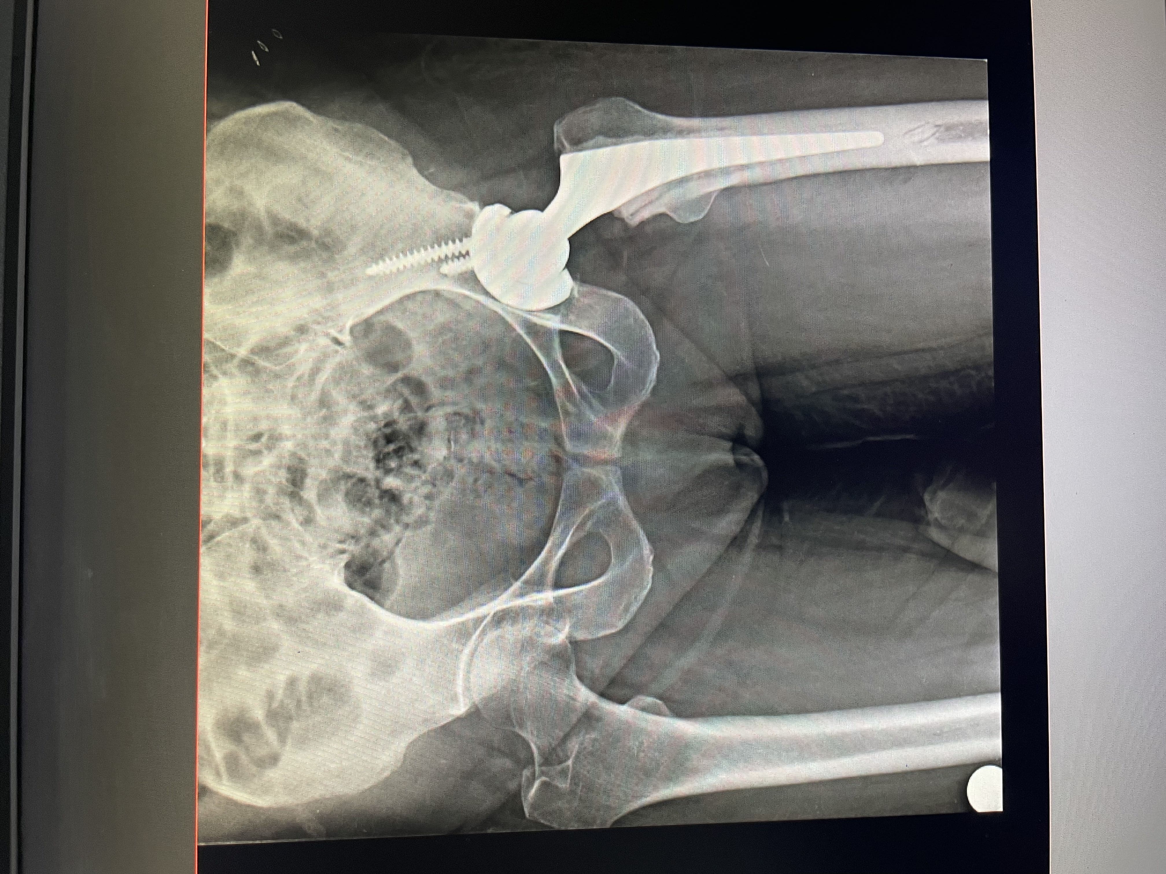 X-Ray of Knee Replacement 1