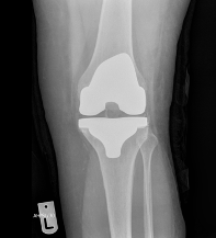 X-Ray of Knee Replacement 1