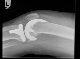 X-Ray of Knee Replacement 2