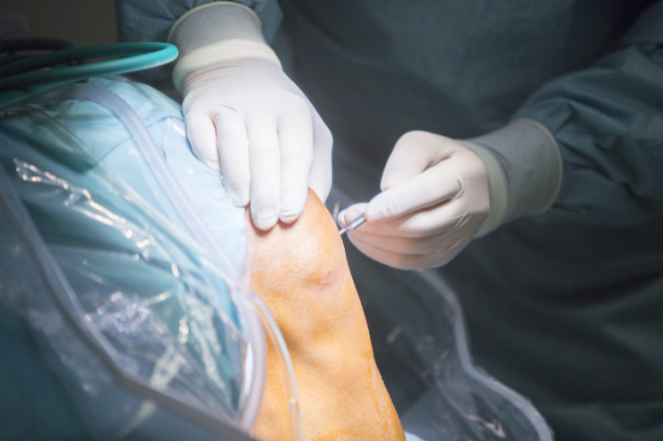 Knee Arthroscopy